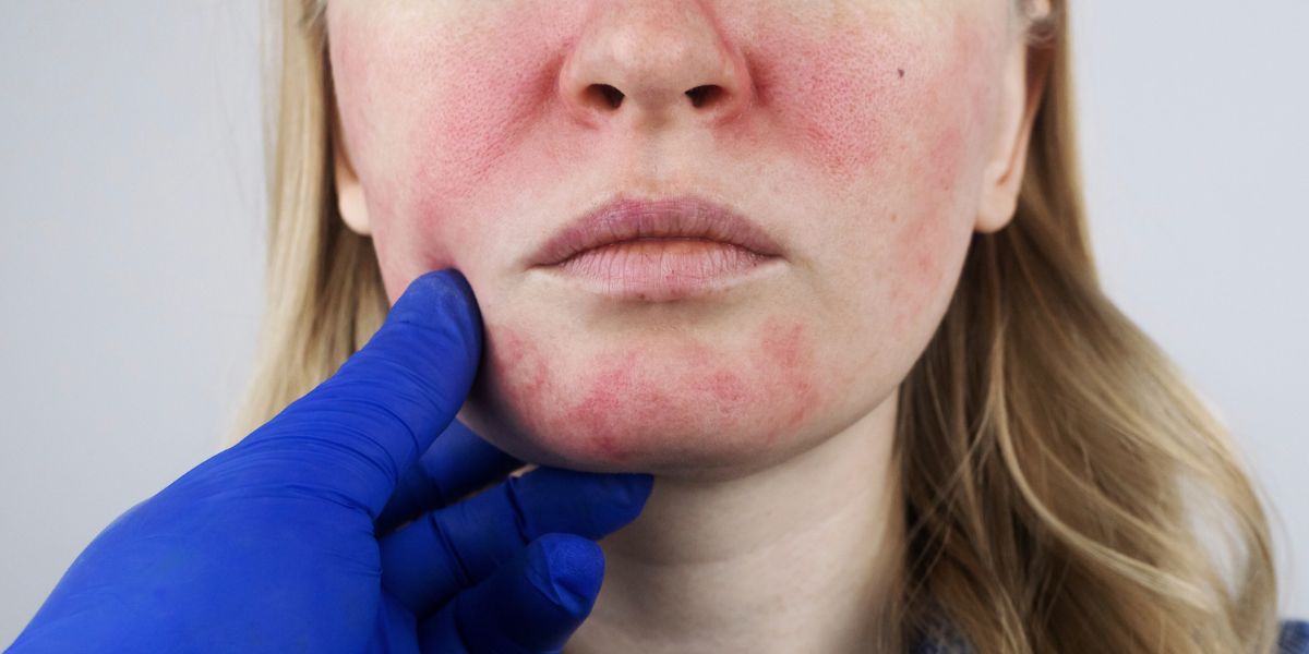 Cuidados e Tratamentos Eficazes para Pele Rosácea