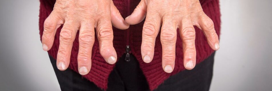 Rizartrose do Polegar: Causas Diagnóstico e Tratamento