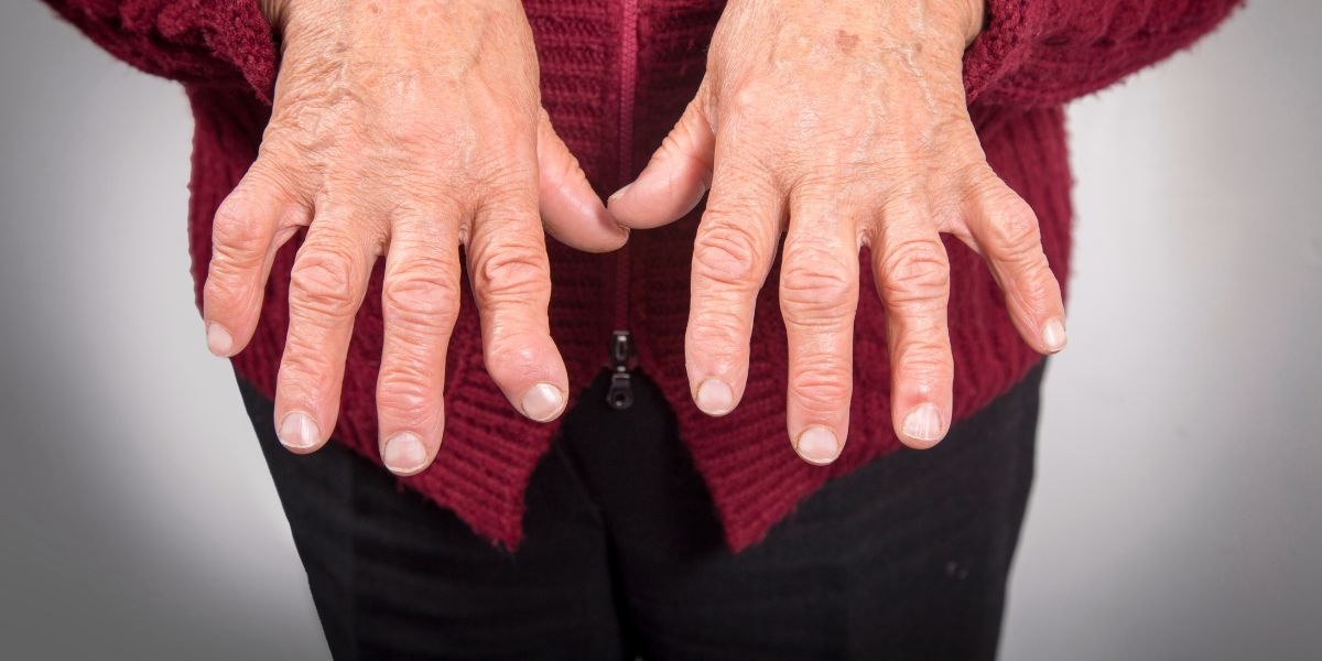Rizartrose do Polegar: Causas Diagnóstico e Tratamento