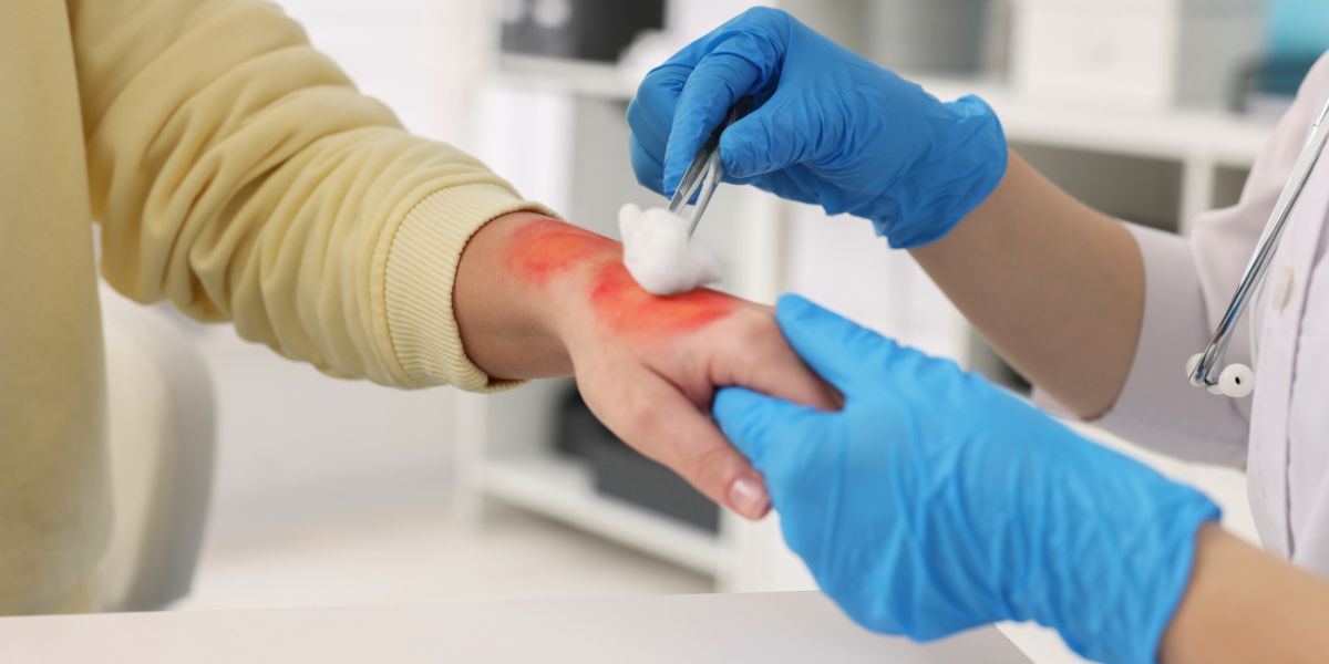 Silvederma: Tratamento Eficaz para Queimaduras e Infeções